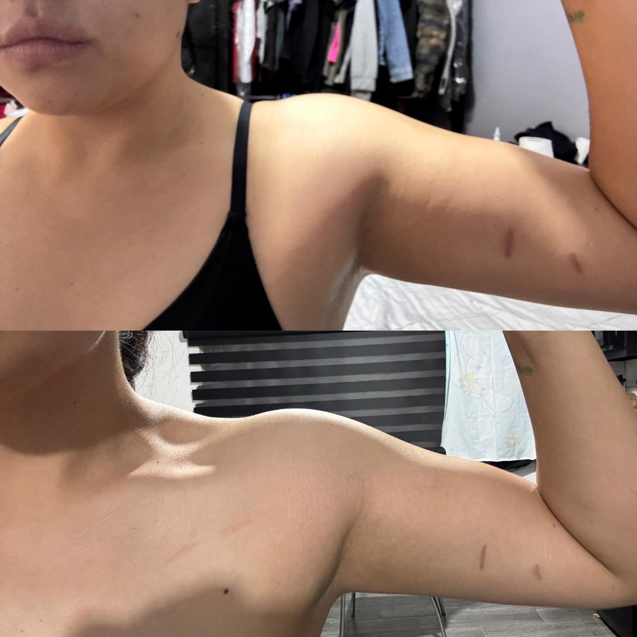 Mejora en tono muscular de brazo de Pam en CROSS 144